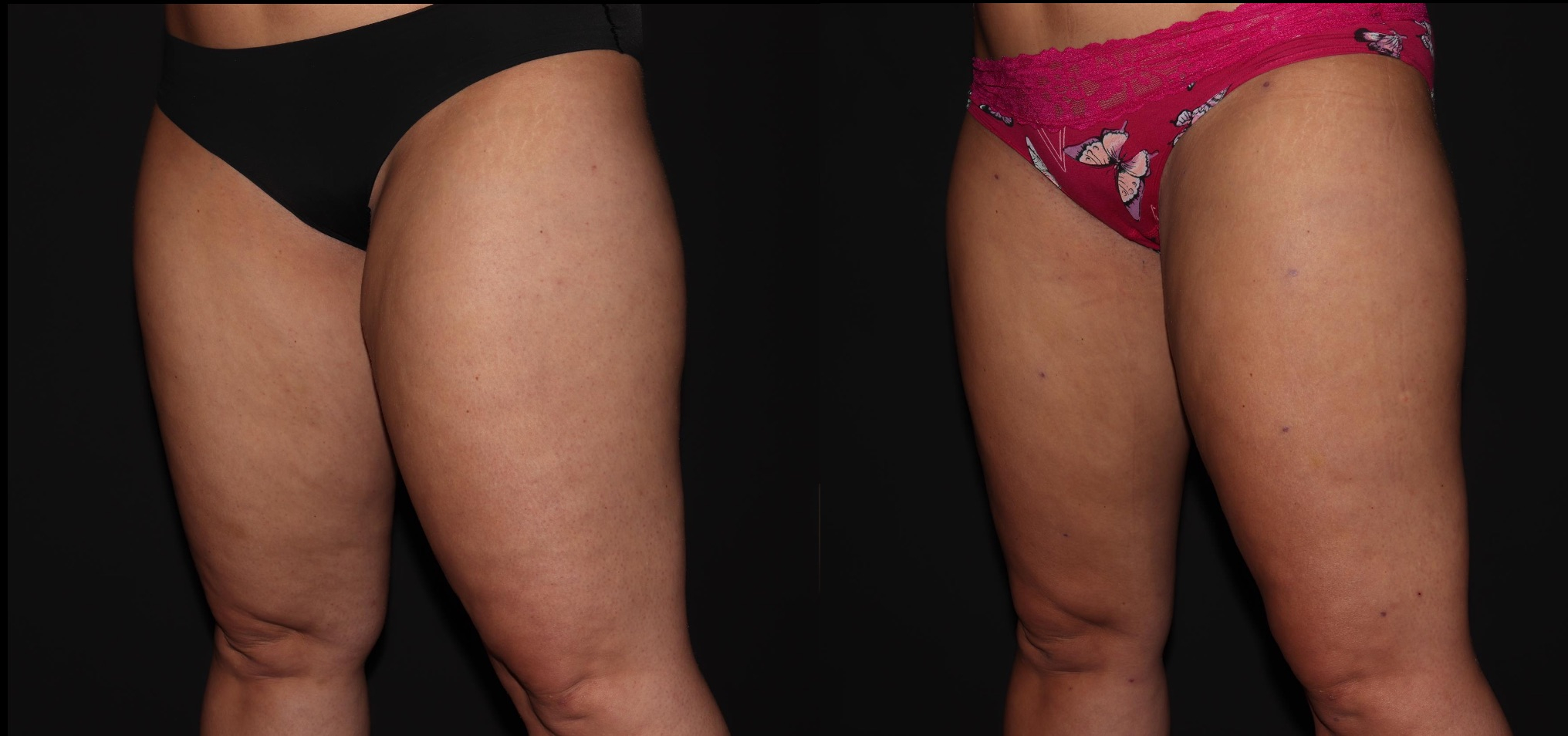 Before and After Image: Liposuction – Thighs - left-front-oblique
